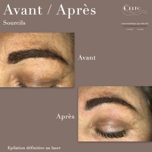 Avant après sourcils 2