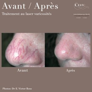 Avant/Après traitement au laser varicosités nez